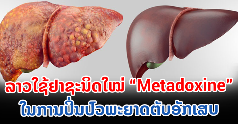 ອະນຸຍາດຈຳໜ່າຍຢາ Metadoxine ໃນ​ການ​ປິ່ນປົວ​ພະຍາດ​ຕັບ​ອັກເສບ